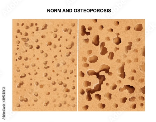 illustration of the Process of osteoporosis