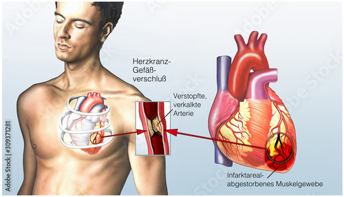 Angina Pectoris. Herzinfarkt