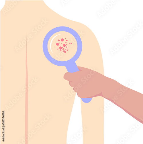 A dermatologist examines a patients skin with a magnifying glass.