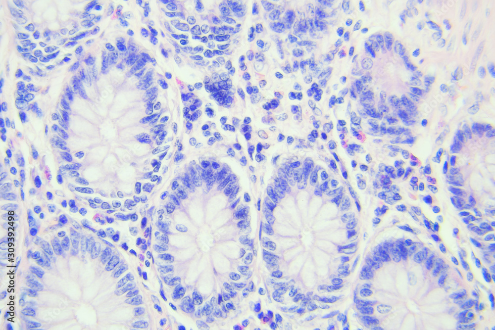 Colon cancer microscopic photography, magnification x400 Colon cancer microscopic photography, magnification x400