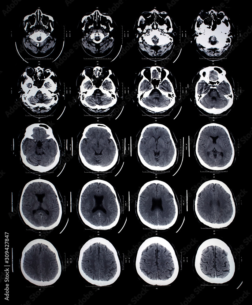 Head xray film images used to diagnose neurological and tumor diseases
