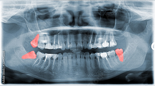 Dental X-ray Picture Of Jaw With Wishdom Teeth photo