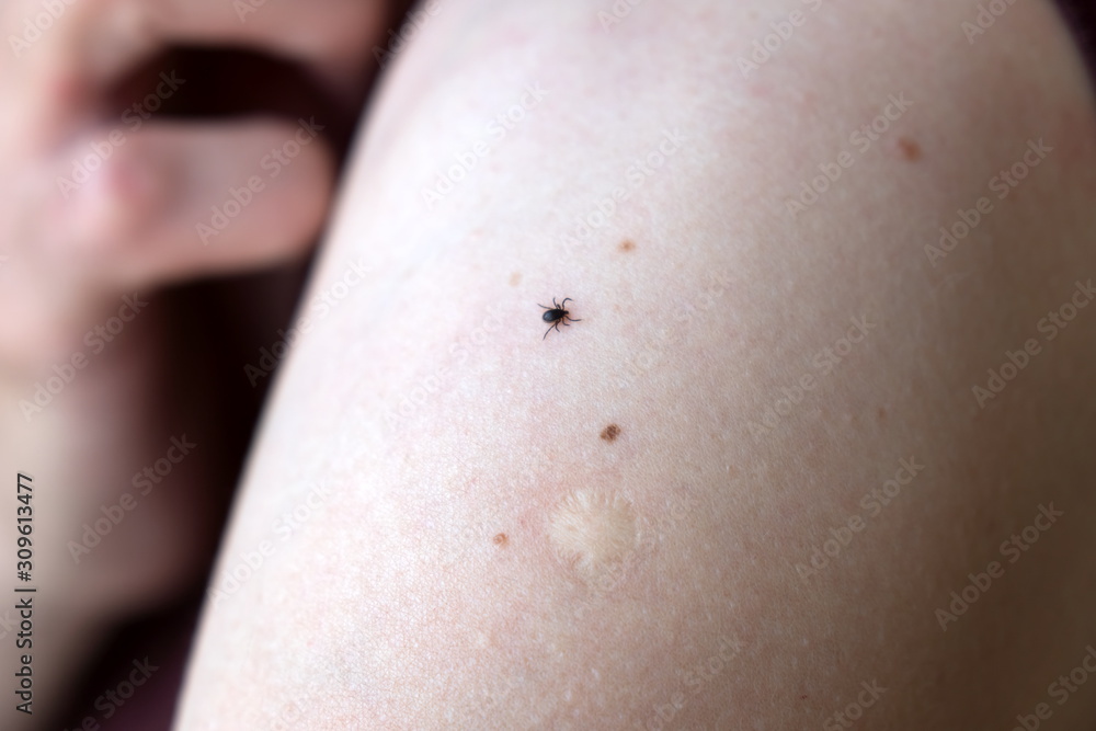 A dangerous encephalitis tick (Ixodes ricinus) creeps on a person’s forearm. A dangerous encephalitis tick (Ixodes ricinus) creeps on a person’s forearm.