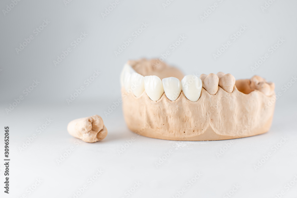 Close-up on plaster model of artificial jaw with veneers and tooth on the white background. Concept of prosthetics and implantation in dentistry Close-up on plaster model of artificial jaw with veneers and tooth on the white background. Concept of prosthetics and implantation in dentistry