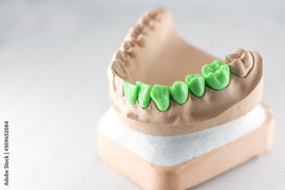 Close-up on plaster model of artificial jaw with teeth painted in green ...
