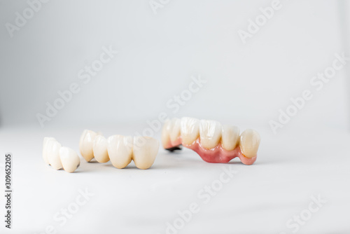Close-up on dental crowns on the white background. Concept of prosthetics and implantation in dentistry