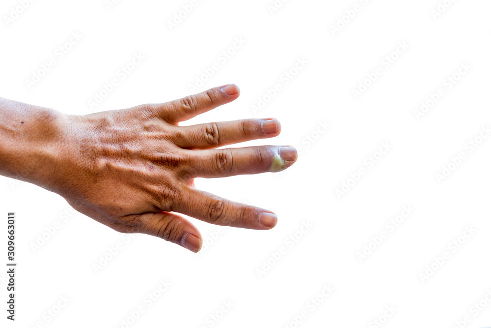 Paronychia, swollen finger with fingernail bed inflammation due to bacterial infection on a