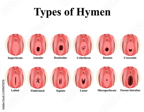 Types of hymen. Imperforate, annular, Denticular, Cribriform, dentate, Crescentic, Labial, Fimbriated, Septate, lunar, Microperforate. Hymen after defloration. Infographics. Vector illustration. photo