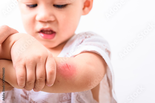 Asian boy kid show arm accident wound he painful abrasion scratches from fall photo