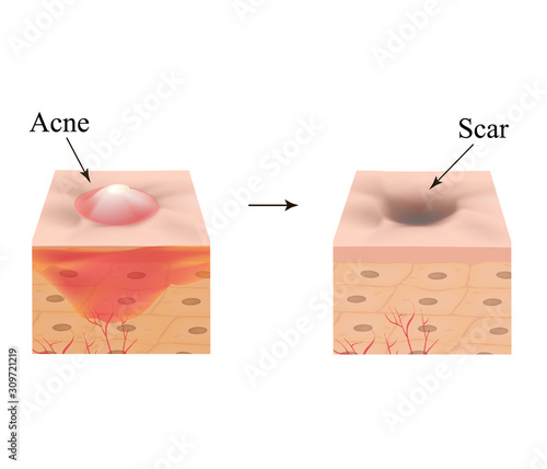 Inflamed acne on the skin. Inflamed pimple. The structure of the skin. Acne scar. Infographics. Vector illustration on isolated background.