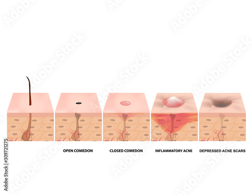 Treatment of open comedones, inflamed acne, acne cysts. Sore acne. structure of the skin. Treatment of scars of acne and pimples. blackheads. Infographics. Vector illustration on isolated background.