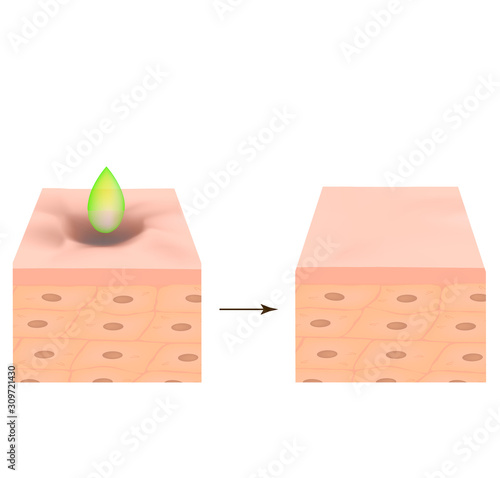 Acne scars. Acid peeling scar atrophic treatment. The anatomical structure of the skin with acne. Vector illustration on isolated background.