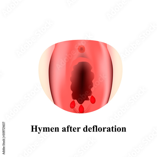 The structure of the vulva hymen. Hymenoplasty. Hymen after defloration. Female genital organs. Infographics. Vector illustration on isolated background.