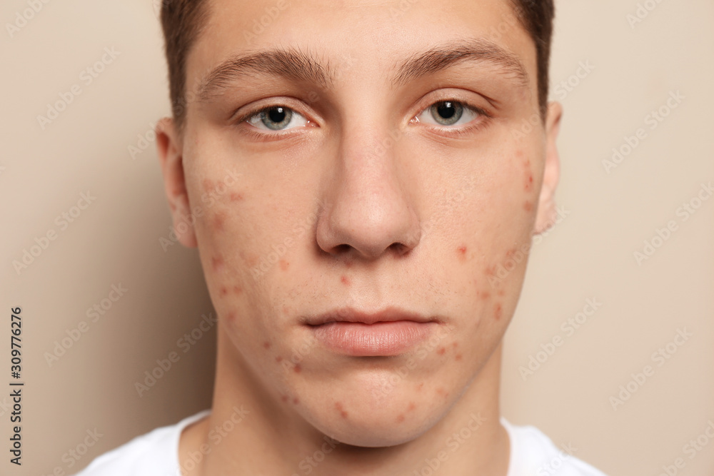 Teen guy with acne problem on beige background, closeup Teen guy with acne problem on beige background, closeup