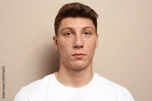 Teen guy with acne problem on beige background © New Africa