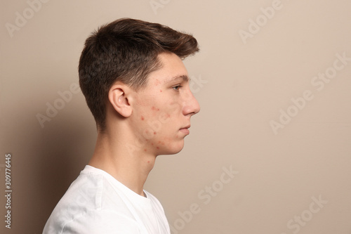 Teen guy with acne problem on beige background. Space for text