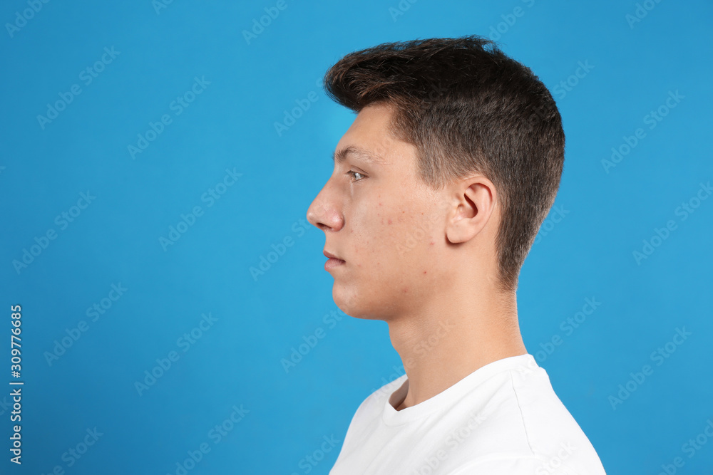 Teen guy with acne problem on blue background. Space for text Teen guy with acne problem on blue background. Space for text