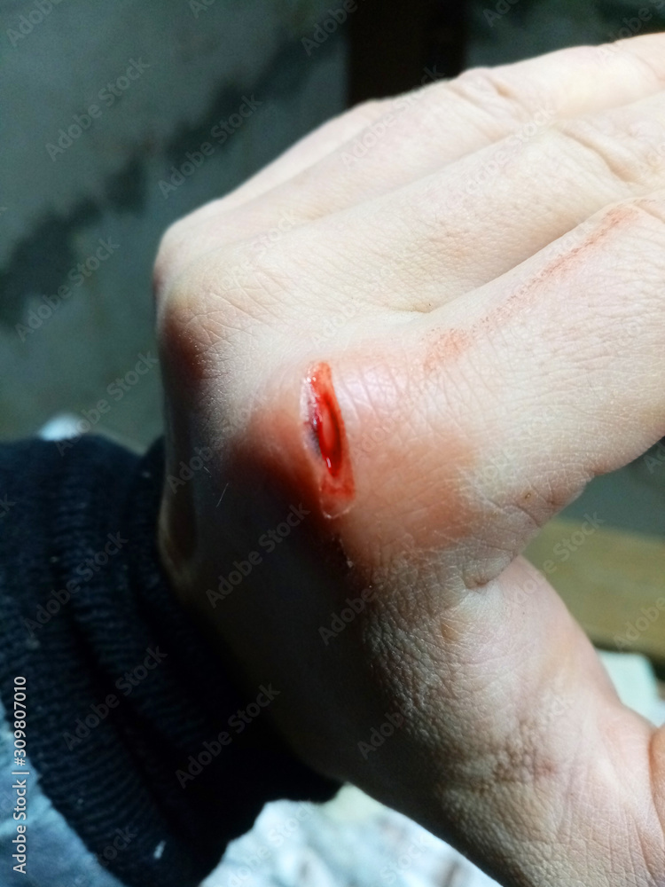hand injury. skin damage and bleeding. hand injury. skin damage and bleeding.