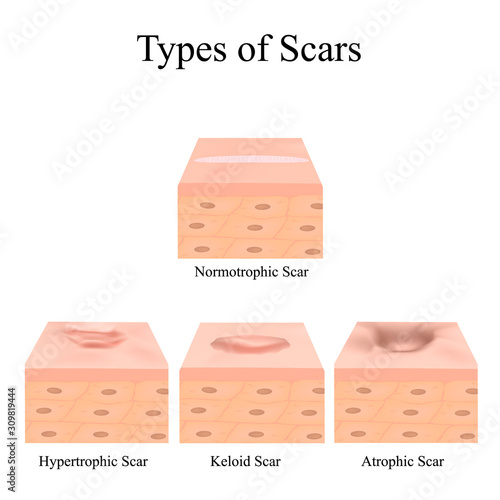 Types of scars. Acne scars. Keloid, hypertrophic, atrophic, normotrophic. The anatomical structure of the skin with acne. Vector illustration on isolated background.