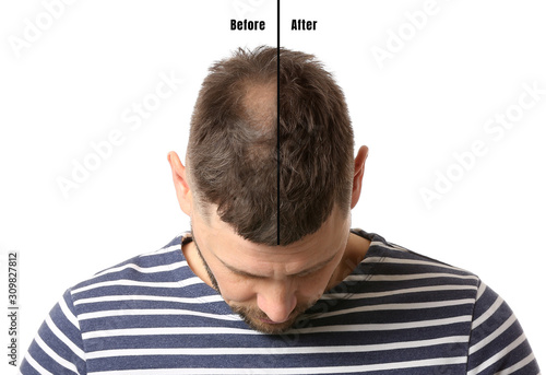 Obraz na plátně Man before and after hair loss treatment on white background
