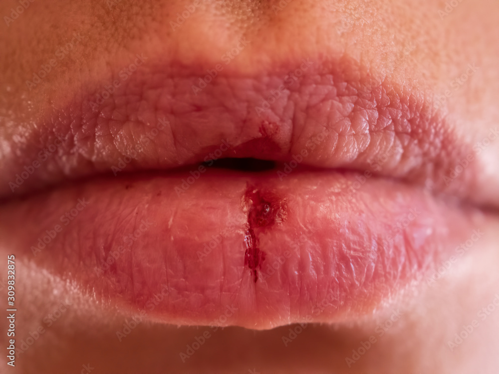 Obraz premium Close-up pale female lips cracked from frost, wind, lack of vitamins. Herpes disease virus wound. Lips need hygiene. Mature woman 35 years oldsuffering from herpes