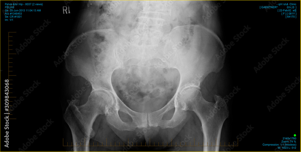 Negative computer XRay of a hip showing joints needing replacement