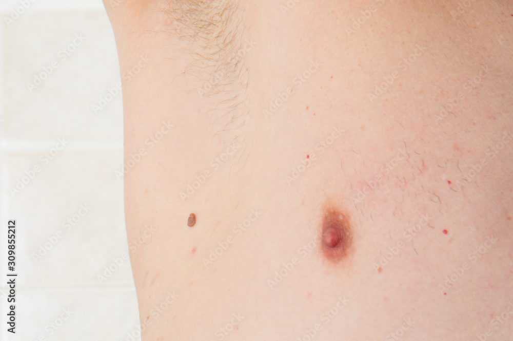 Fototapeta premium skin wart