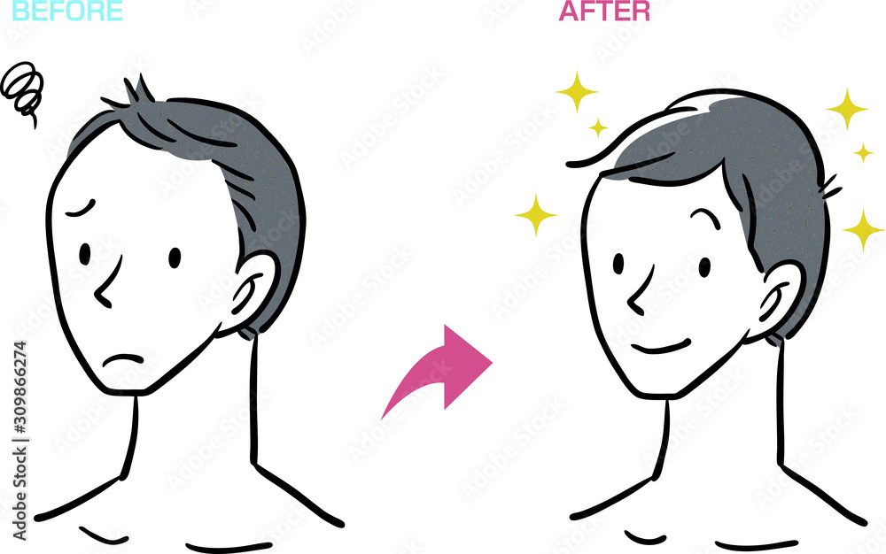 薄毛 男性 Aga ベクター イラスト Stock Vector Adobe Stock 薄毛 男性 Aga ベクター イラスト Stock Vector Adobe Stock