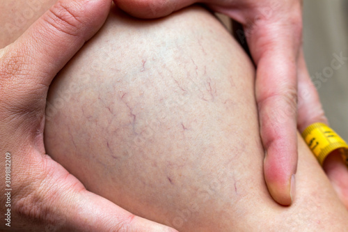 Varicose veins on a woman’s hip after childbirth