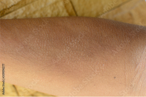 Closeup Keratosis pilaris on skin. Can used for dermatitis content or healthcare concepts.