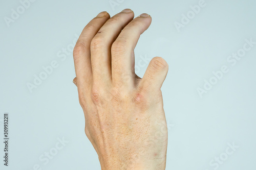caucasian man hand with amputaded Little finger isolated on White background 
