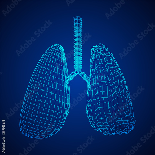 Healthy and sick lung with trachea bronchi internal organ human. Pulmonology medicine science technology concept. Wireframe low poly mesh vector illustration