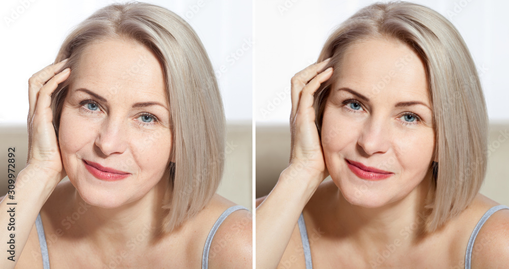 Middle age close up woman happy face before after cosmetic procedures. Skin care for wrinkled face. Before-after anti-aging facelift treatment. Facial skincare and contouring. Middle age close up woman happy face before after cosmetic procedures. Skin care for wrinkled face. Before-after anti-aging facelift treatment. Facial skincare and contouring.