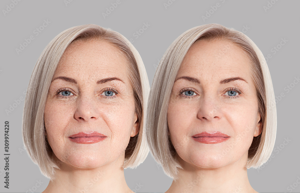 woman-middle-age-face-before-and-after-collagen-face-injection-wrinkle