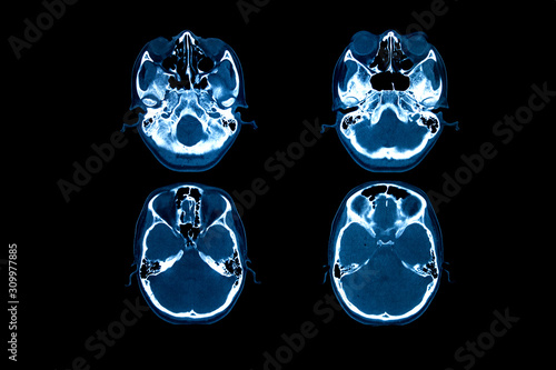 Fototapeta Naklejka Na Ścianę i Meble -  X-Ray image of human brain
