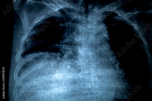 X-Ray Image Of Human Chest for a medical diagnosis