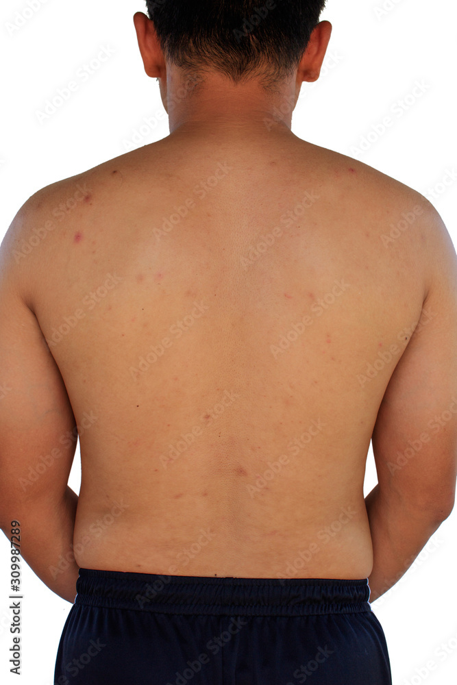 Fototapeta premium Man with acne with red spots on the back on white background.