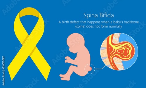 Spina bifida birth defects infant disease