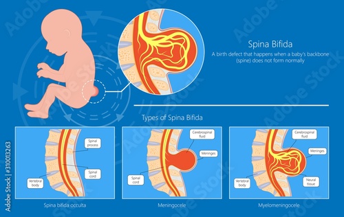 Spina bifida birth defects infant disease photo