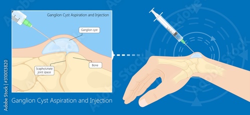 Ganglion cyst disease hand wrist trauma photo