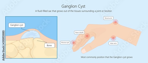 Ganglion cyst disease hand wrist trauma