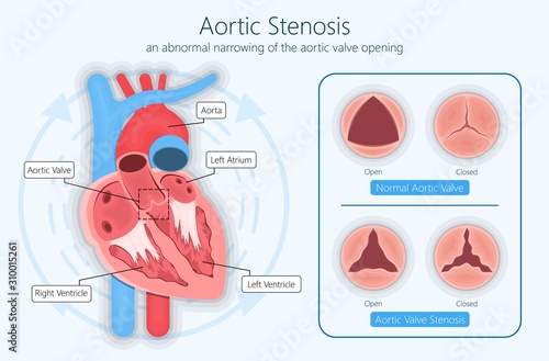 Transcatheter aortic valve replacement (TAVR) minimally invasive surgery