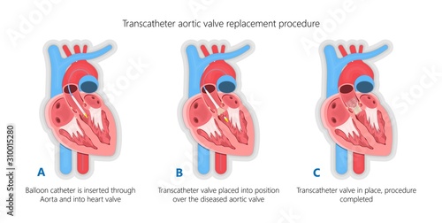 Transcatheter aortic valve replacement (TAVR) minimally invasive surgery