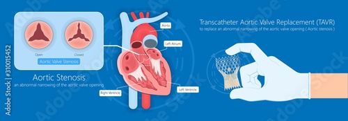 Transcatheter aortic valve replacement (TAVR) minimally invasive surgery