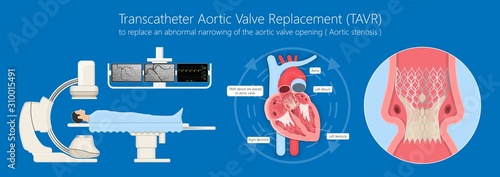 Transcatheter aortic valve replacement (TAVR) minimally invasive surgery photo