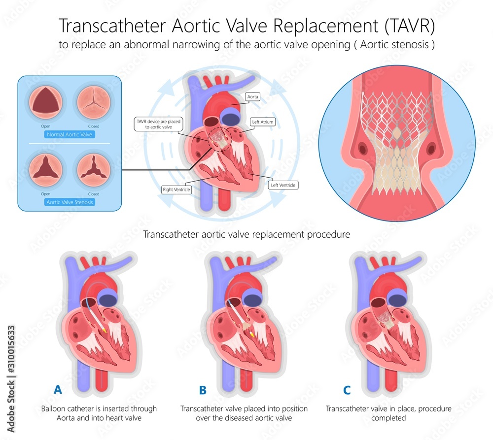 Transcatheter aortic valve replacement (TAVR) minimally invasive surgery
