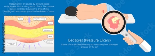 Bedsores (pressure ulcers) injuries skin underlying tissue from lying down or sitting prolonged period time with paralysis patient and immobility adults
