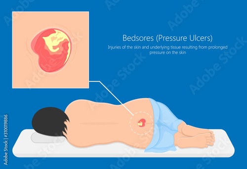 Bedsores (pressure ulcers) injuries skin underlying tissue from lying down or sitting prolonged period time with paralysis patient and immobility adults