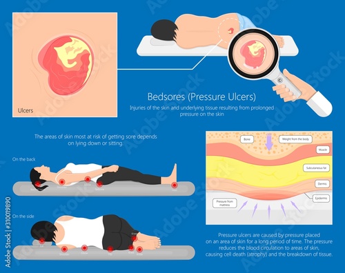 Bedsores (pressure ulcers) injuries skin underlying tissue from lying down or sitting prolonged period time with paralysis patient and immobility adults