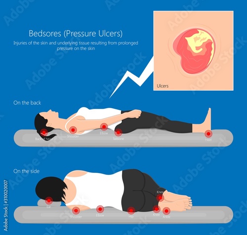 Bedsores (pressure ulcers) injuries skin underlying tissue from lying down or sitting prolonged period time with paralysis patient and immobility adults